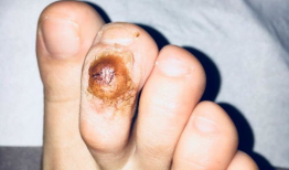 去除鸡眼视频,跟随视频教程学除法